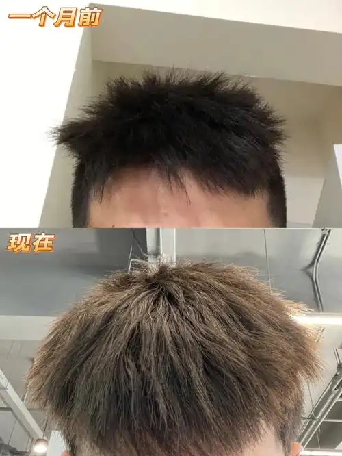 锡纸烫一个月后变化