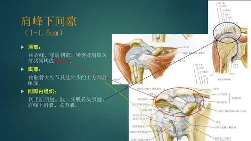 肩峰下撞击综合症