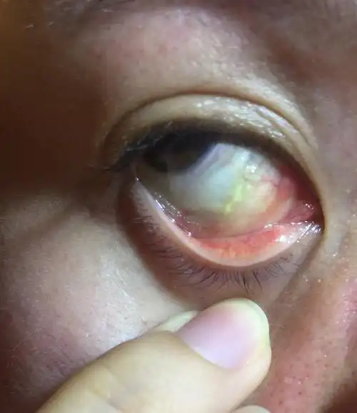 医生解答:你那个泡不是泡性结膜炎,是结膜淋巴管扩张形成的,如果水泡