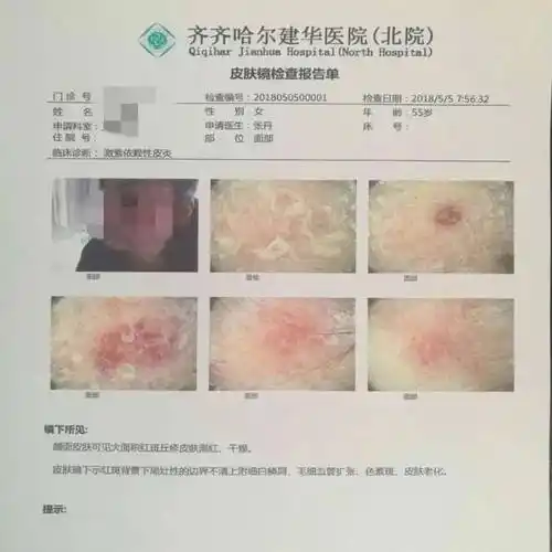 皮肤镜是一种无创的检查技术,价格不及病理检查的1/4,且报告即时立取