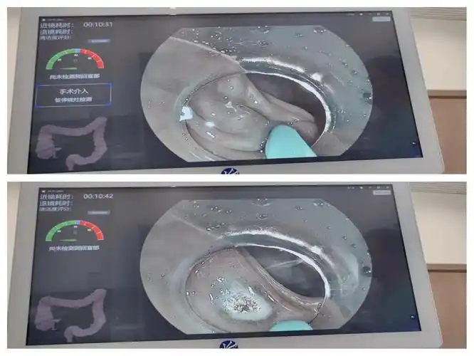 普通肠镜:一次难忘的体验 💩