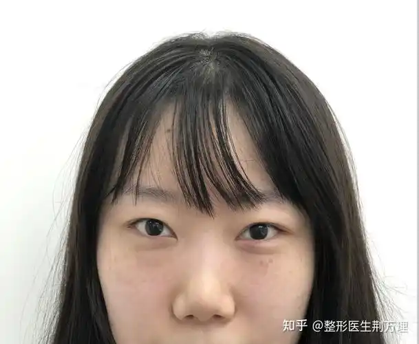 眼部美学标准丨小姐姐6mm宽度平行型双眼皮很不错