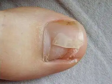 脱甲病指甲一侧缺损一块图