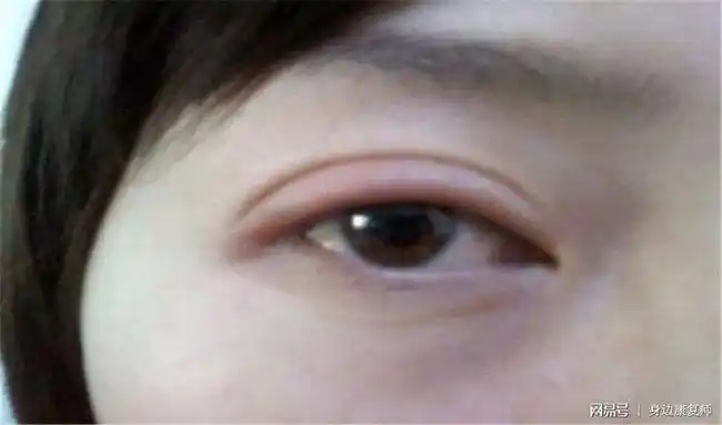 经常眼睑,四肢水肿,为什么会这样呢?该如何做才能消除水肿呢?