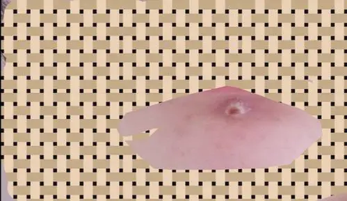 为啥粉刺挤完之后成这个样子了啊慎入