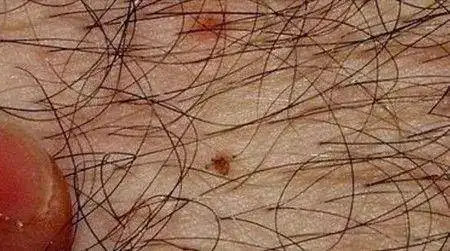 下面痒痒痒,虫子却从睫毛里爬出来了!|阴虱_网易订阅