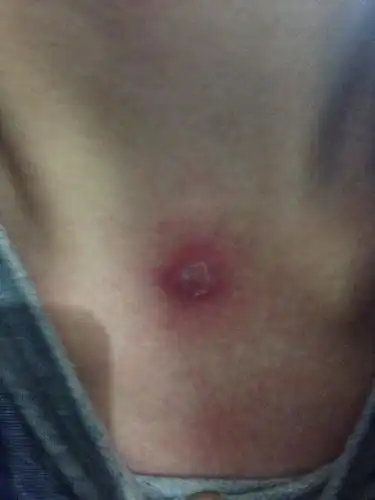 前几天胸口长了个火疖子,刚好,现在脖子正中间又长了个这个东西!