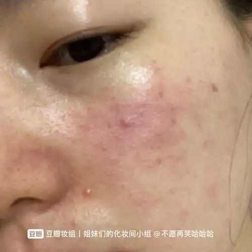 皮肤屏障受损修复交流专用楼