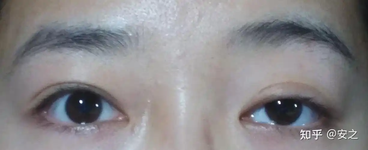 上眼睑下垂怎么办