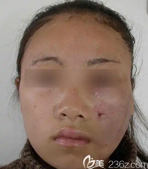 常见类型有三种,分别为:术后皮肤凹凸不平,术后皮肤下垂以及肌肉粘连