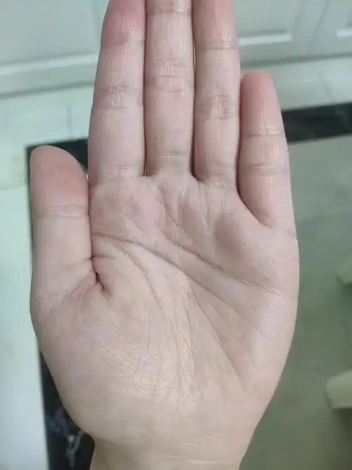 才知道天生老人手其实就是鱼鳞病