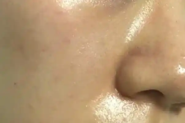 皮肤出油多是什么原因皮肤出油严重毛孔粗大如何改善