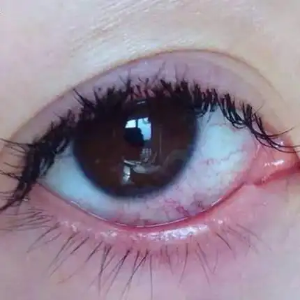 为什么戴完美瞳眼睛都是红血丝眼睛红血丝不注意可能会导致眼瞎