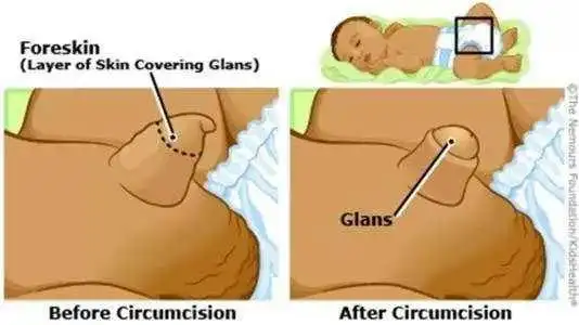 男孩包皮多长算正常男孩包茎多大