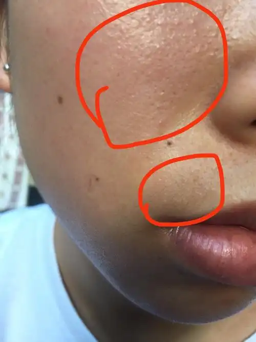 小特别密,混油敏感痘肌,脸两变上个星期去角质伤了后一个星期没洗脸