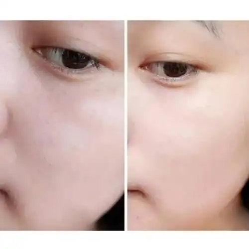 广州谢女士使用前后对比