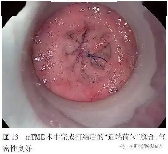 2 "远端荷包"缝合 绝大多数tatme均会使用圆形吻合器完成结肠-直肠