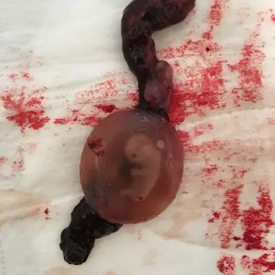 被医生告知为稽流流产,一直没有去清宫,两天后我的