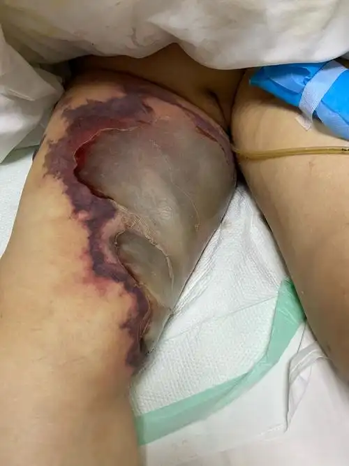 一例极速进展性皮肤坏死病例分享