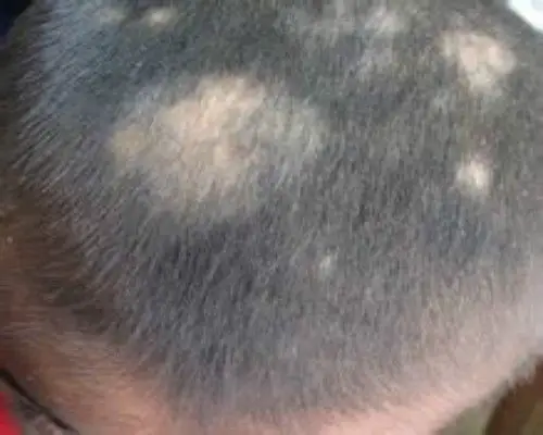 头皮癣早期症状图片5