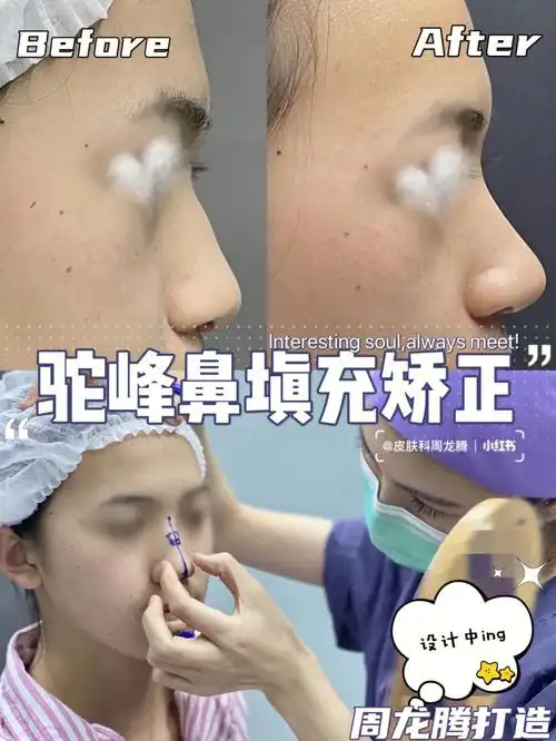 驼峰鼻矫正打造分享,10分钟74鼻型矫正变流畅.