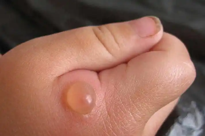 跳蚤咬伤水疱图