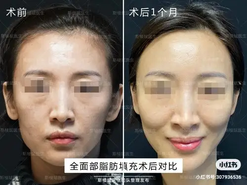 全面部自体脂肪填充后1个月效果对比_脂肪填充_脂肪填充治疗介绍 - 好