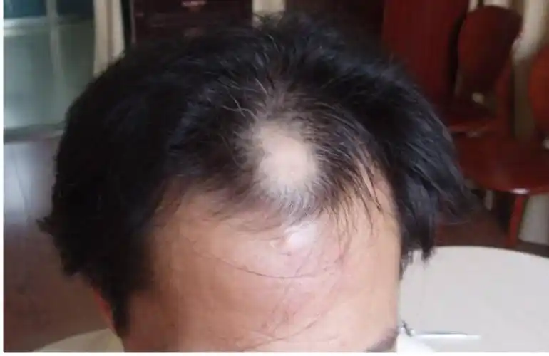 脱发非常严重怎么办 脱发17级程度图片