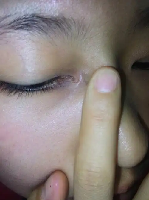 眼睛内角长得包怎么办 是什么包 好久以前就有 但是发现好像最近变大