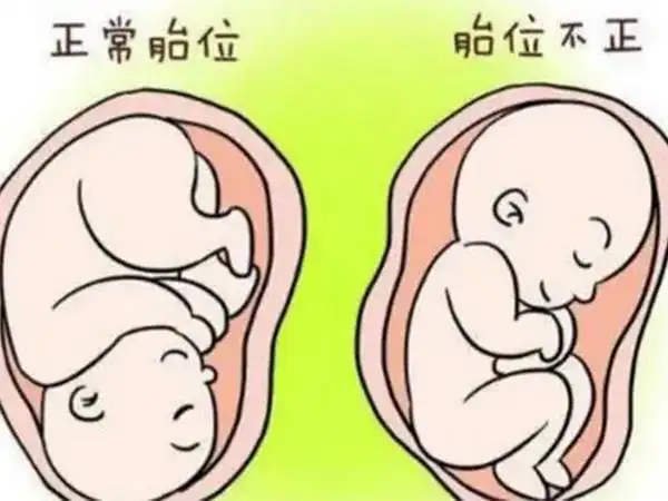 胎位的主要检查方法是b超检查方法/步骤胎儿胎位是指胎儿在子宫内的