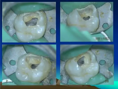 右上颌第一磨牙rct治疗一例赏析第三届萨尼蓝色梦想杯根管大赛