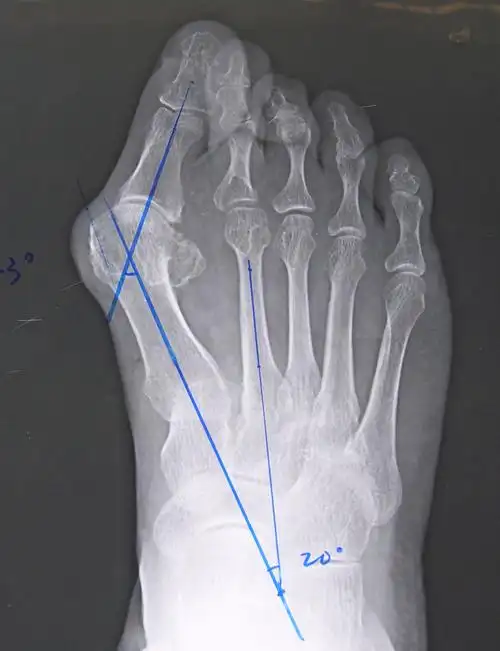 18岁女孩和妈妈都是大脚骨,是遗传吗,怎么治?骨科老牛来支招!