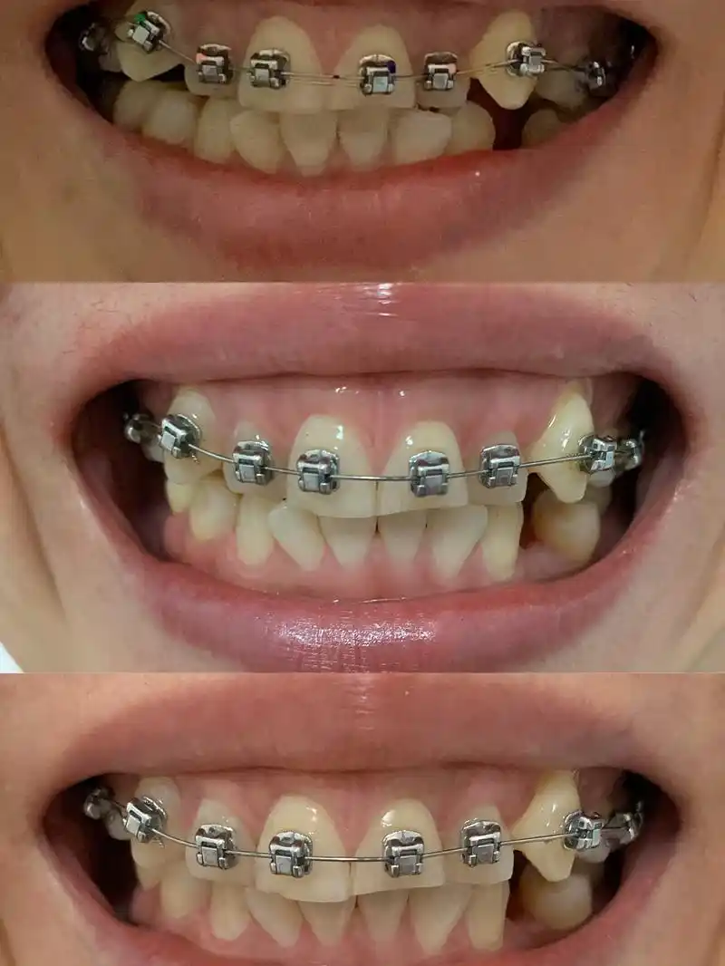 正畸日记5 虎牙 智齿牵引_牙套_正畸_美妆_医美整形