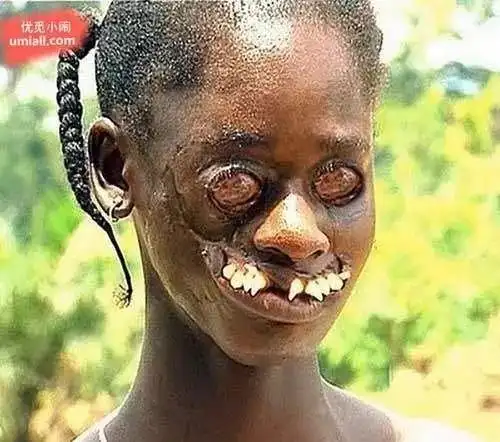 重口慎入,9种世界上恐怖而怪异的罕见疾病!