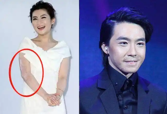 忘记解冻被炸伤,脸部脖子全是伤疤|胡歌|烧伤_网易订阅