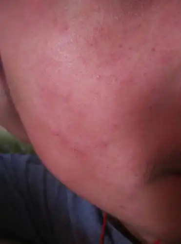 今天不知道什么时候脸上起了一大片这种红,在皮下面起的,怎么回事.