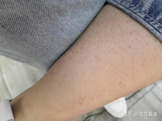 腿部毛囊炎, - 知乎