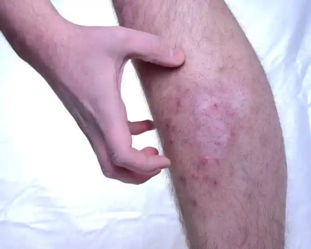 皮肤瘙痒病,痒的皮肤疾病.缺少在皮肤中的色素.