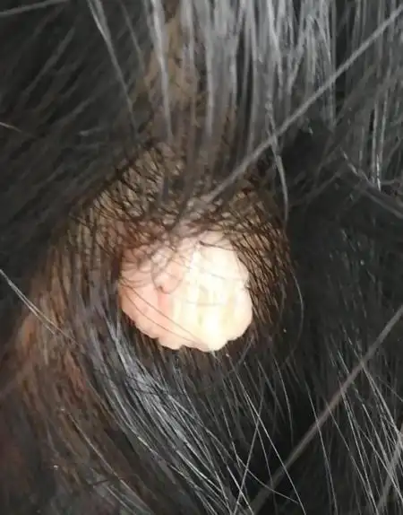 这是hpv疣,不用过于担心,是hpv病毒感染引起的,是抵抗力差的原因.