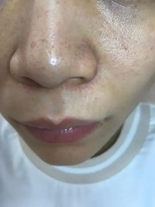 图一:毛孔粗大 油皮 鼻翼两边超多黑头 上妆后出了油细看简直是灾难