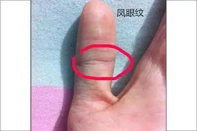 凤眼纹不封闭穷一辈子是真的吗