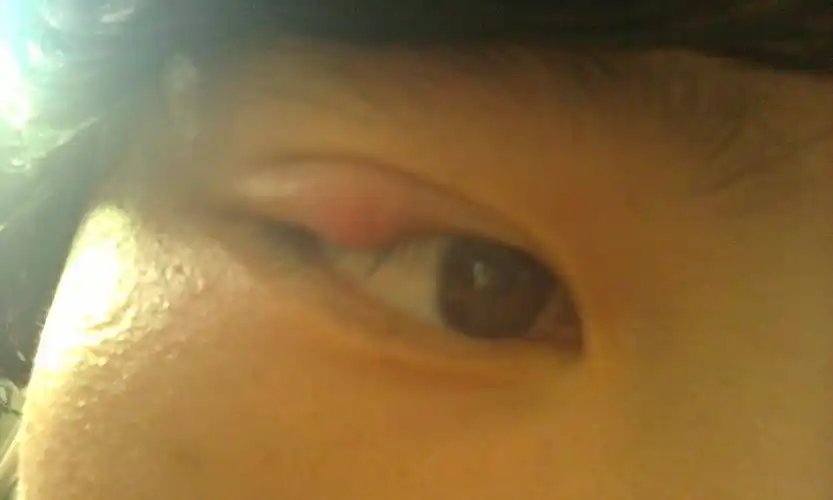 长针眼了.好像有一个月了,还没去看医生