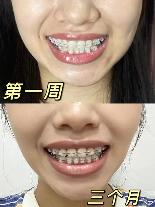 牙套日记眨眼就三个月啦