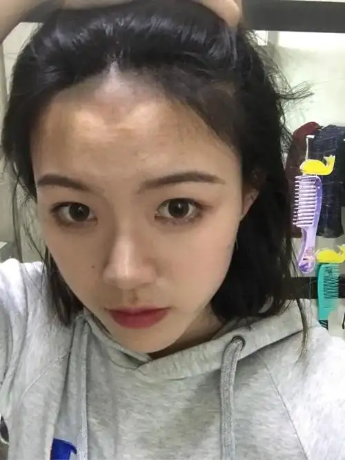 发际线低怎么办