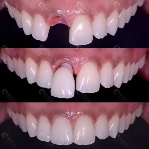 海口雅诺口腔种植牙效果图