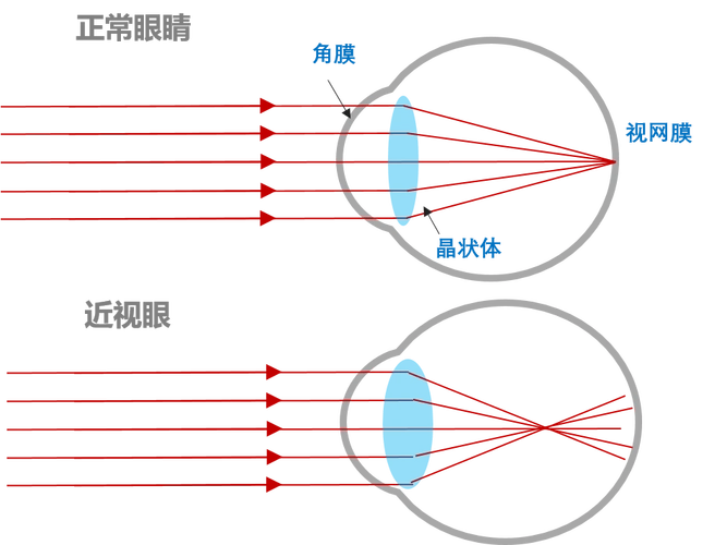 先从近视眼原理说起:当眼在调节放松状态下,平行光线进入眼内,其聚焦