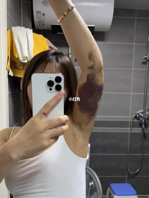 手臂吸脂第12天