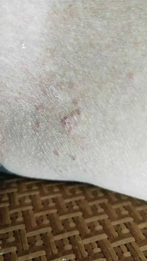 这是什么,在裆部,有点痒.