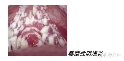 中国女性,75%以上,至少患过一次霉菌性阴道炎,它的主要症状就是,白带