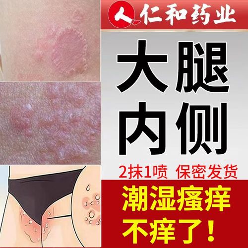 大腿内侧瘙痒根部潮湿膏男女下身止宁舒痒发变黑红喷雾疹长疙瘩 雾疹